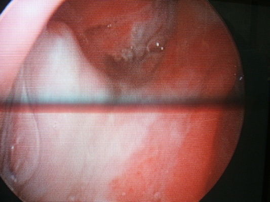 metastatic squamous cell carcinoma #9